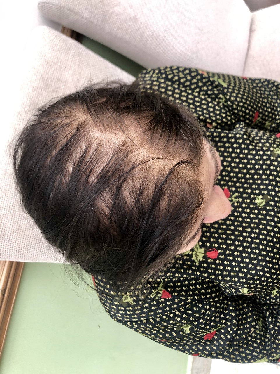 Unveiling the Truth: Understanding Female Pattern Baldness